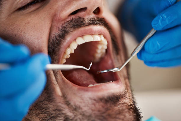 Best Emergency Wisdom Teeth Removal in Tarrant, AL