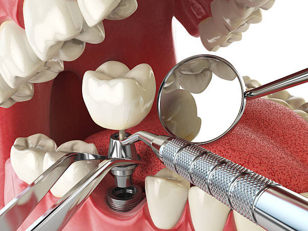 Best Emergency Root Canal Treatment in Tarrant, AL
